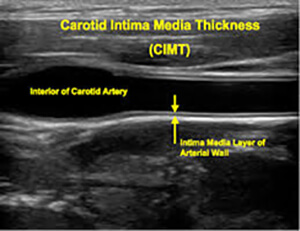 Normal Carotid Artery Ultrasound