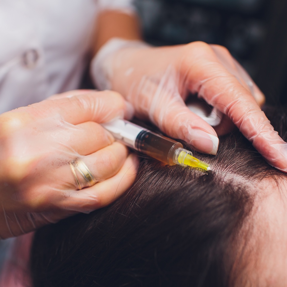 Platelet rich plasma injection procedure. Hair growth stimulation. PRP therapy process