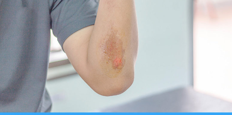 Abrasion (Scrape): How To Treat