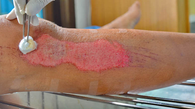 What Are The Difference Between Abrasion VS. Laceration?
